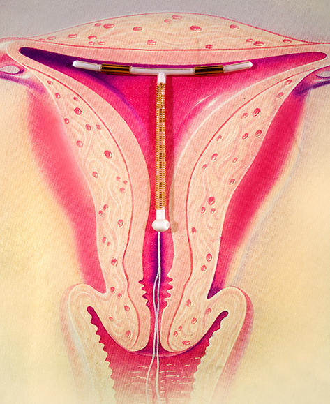 iud_illustration-b29da2.jpg